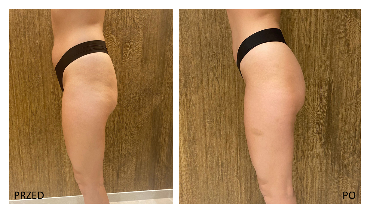 endermologia-efekty