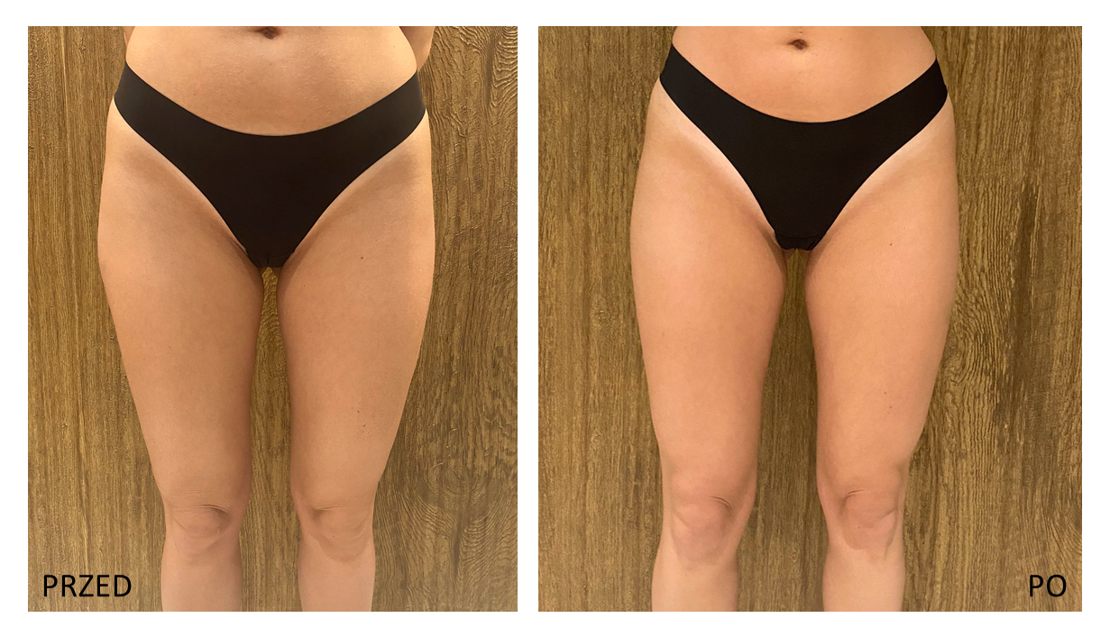 endermologia-efekty